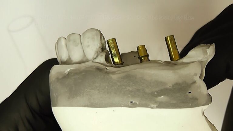 Case with 3Tibase® from Dynamic Abutment® Solutions